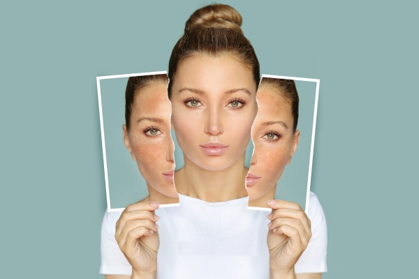 skin lightening treatment images 4